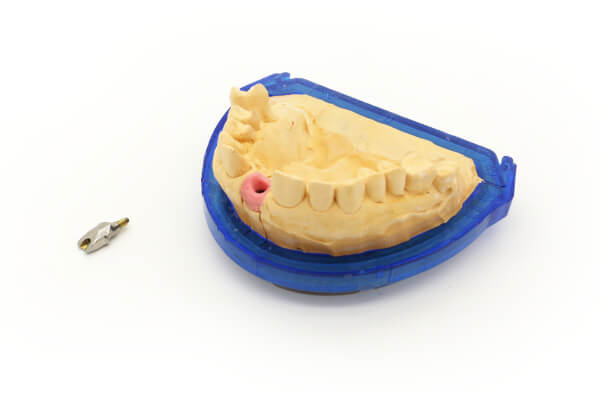 Moderne Implantologie Weyand Dental Labor Homburg.jpg